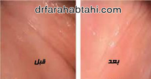 رفع تیرگی واژن با لیزر