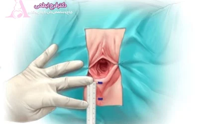 عمل پرینورافی به چه منظور انجام می شود؟