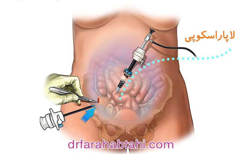لاپاراسکوپی رحم چگونه انجام می شود؟
