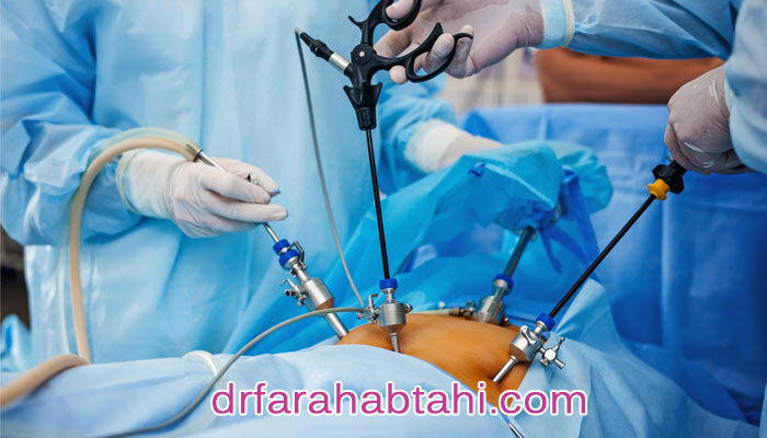 لاپاراسکوپی رحم