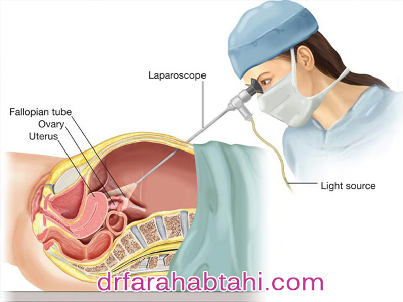 مراقبت های بعد از عمل لاپاراسکوپی