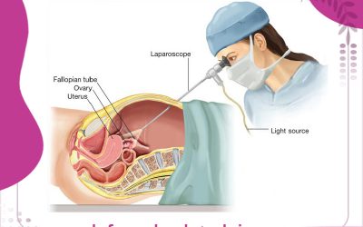 کاربرد عمل لاپاراسکوپی رحم