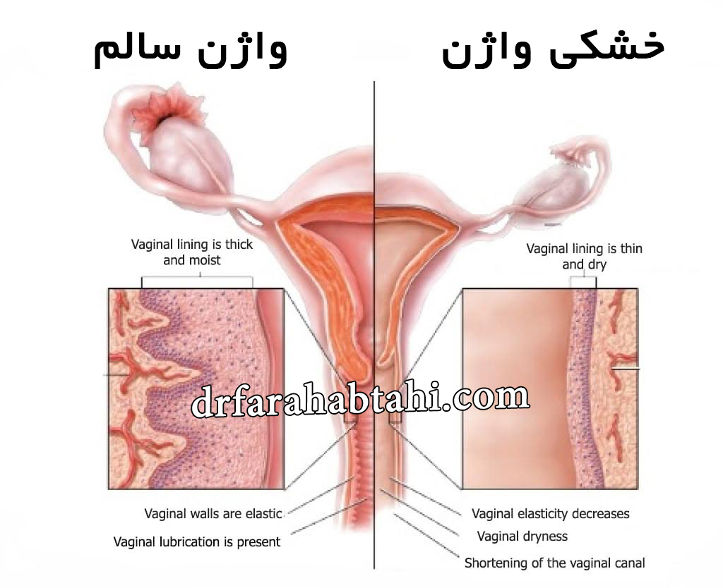 خشکی واژن