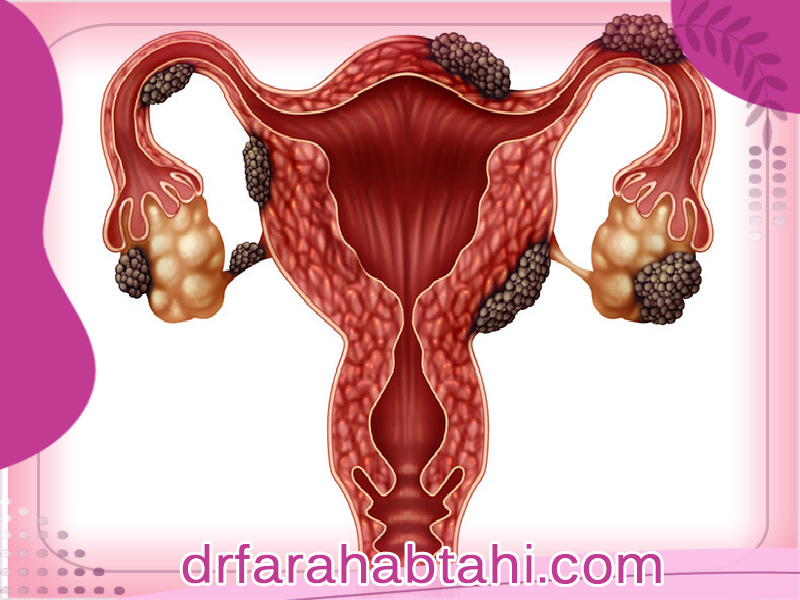 آندومتریوز