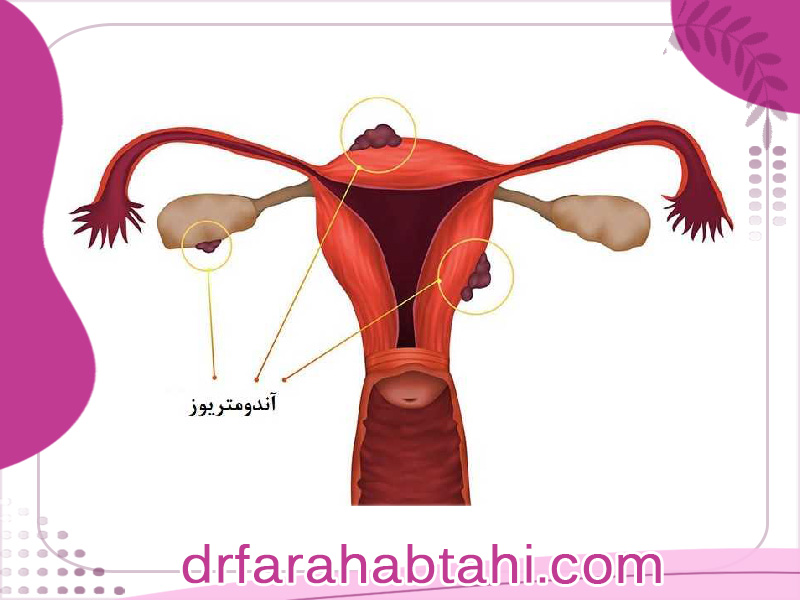 درمان آندومتریوز