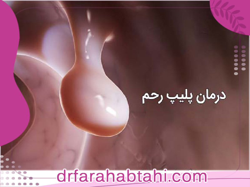 درمان پولیپ رحم