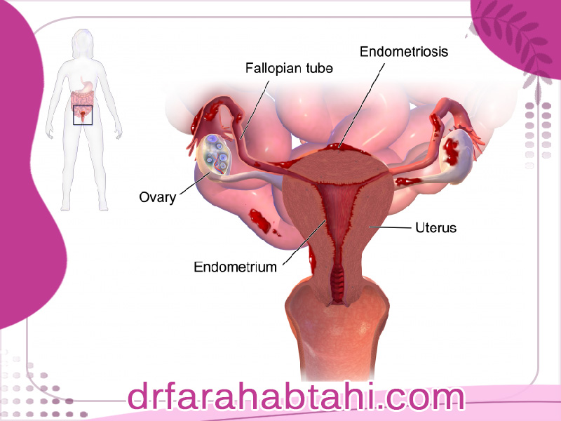 علائم آندومتریوز