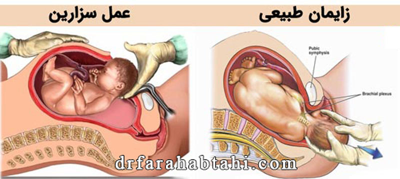 مزیت زایمان طبیعی نسبت به سزارین