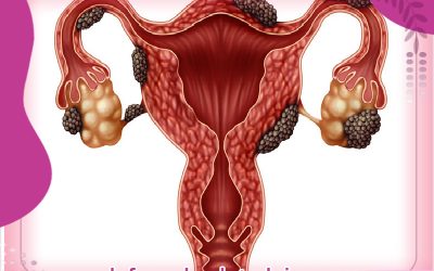 آندومتریوز چیست؟