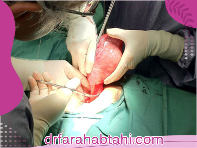 عمل هیسترکتومی در چه مواقعی انجام می شود؟