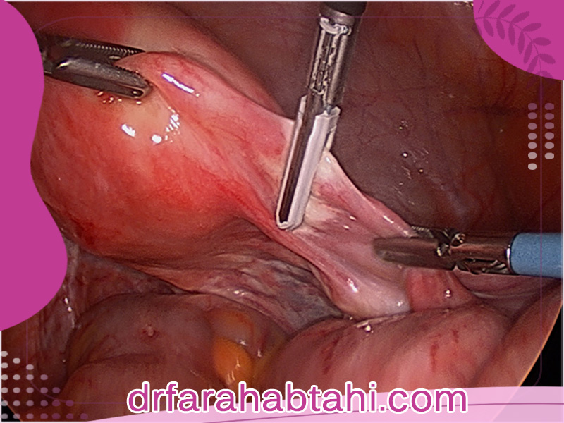 مراحل انجام هیسترکتومی