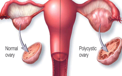 کیست های خطرناک تخمدان