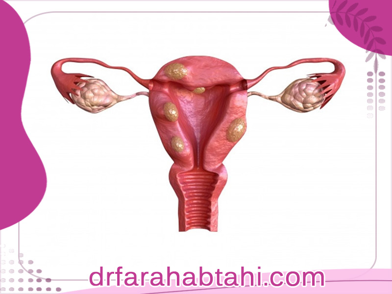 فیبروم رحم