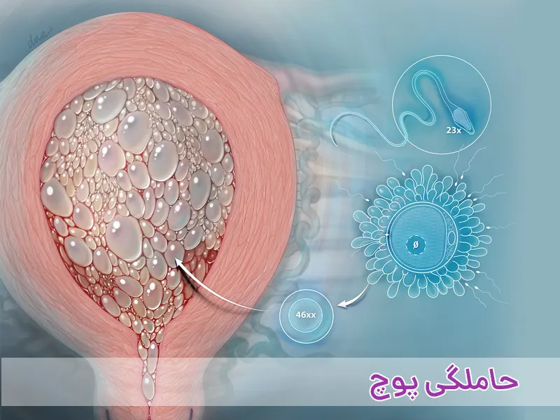 حاملگی پوچ