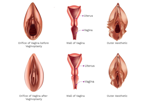 نکاتی که قبل از تنگ کردن واژن باید به آن دقت کنیم