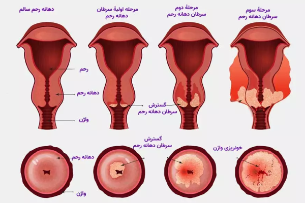 مراحل سرطان دهانه رحم مراحل سرطان دهانه رحم