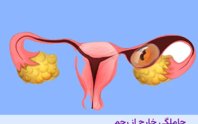 حاملگی خارج از رحم چیست؟