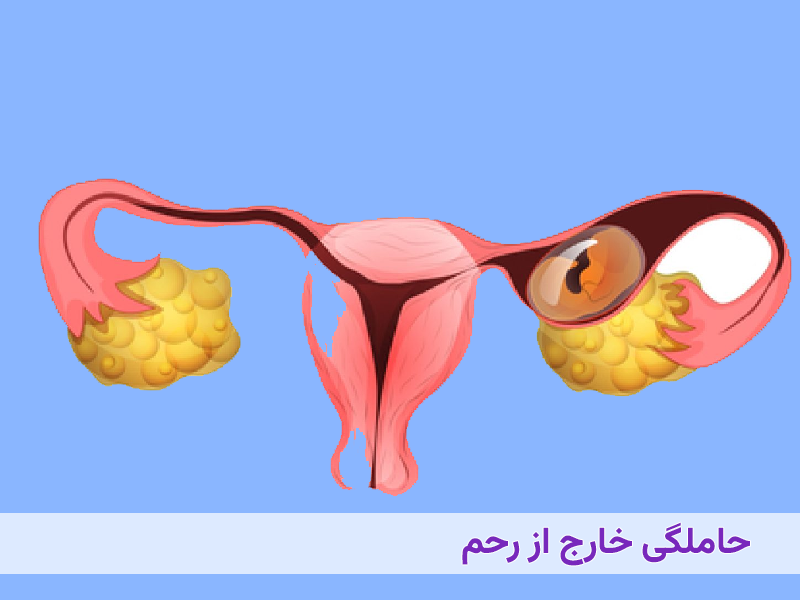 حاملگی خارج از رحم