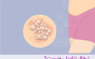 تبخال تناسلی چیست و چگونه درمان میشود؟