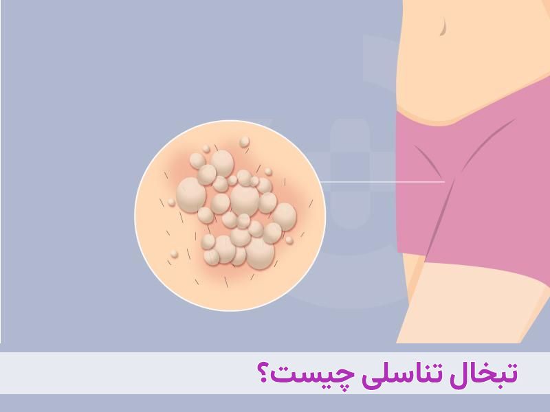 تبخال تناسلی