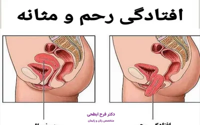 بهترین دکتر درمان افتادگی رحم در ساری