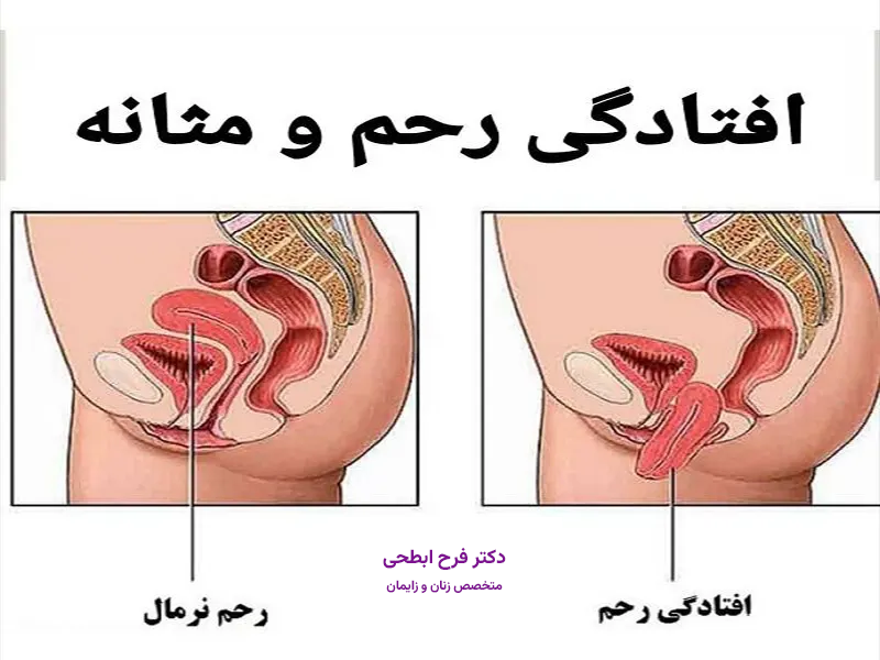 درمان افتادگی رحم