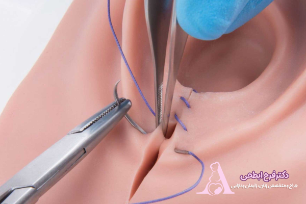 مراقبت از بخیه_های لابیاپلاستی اهمیت مراقبت از بخیههای لابیاپلاستی