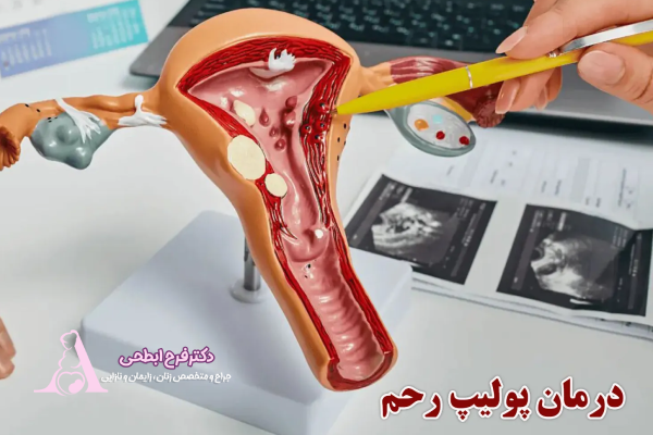 پولیپ رحم و ناباروری