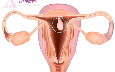 تاثیر پولیپ رحم بر باروری