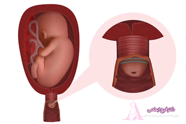 پولیپ آندومتر و تاثیر آن بر لانه گزینی جنین