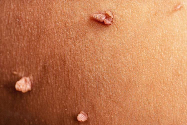 زگیل تناسلی چیست؟