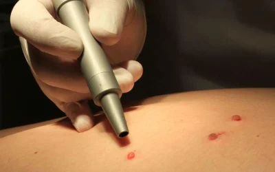 درمان زگیل تناسلی با لیزر: روشی سریع، موثر و ایمن