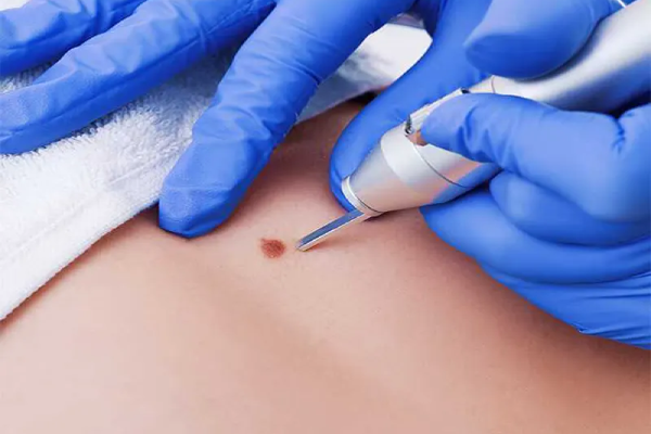 مزایای درمان زگیل تناسلی با لیزر