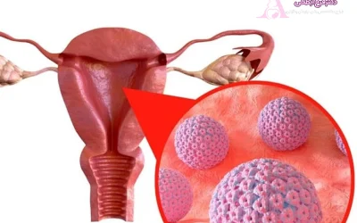 بارداری با اچ پی وی