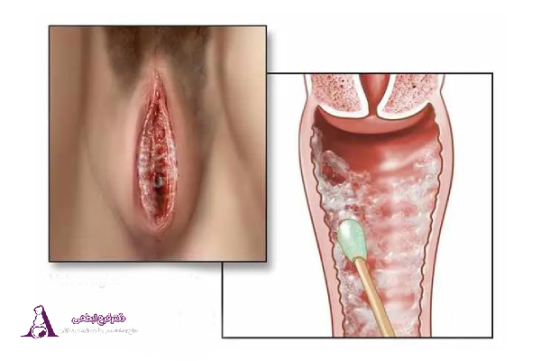 عفونت واژن چیست؟