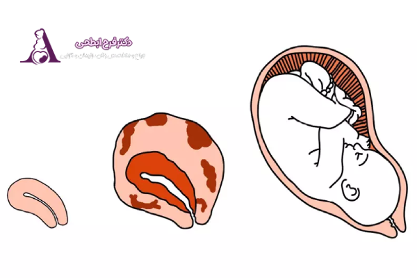 شیوع آندومتریوز در زنان