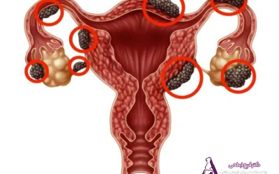 امکان بارداری با آندومتریوز وجود دارد؟