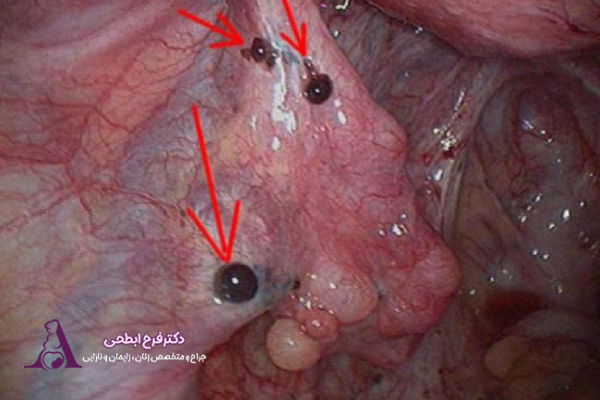 امکان بارداری با آندومتریوز چقدر است؟