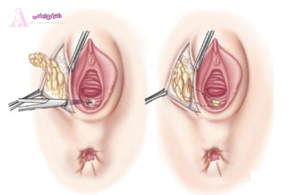 مزایای انجام لابیاپلاستی با وجود هزینه