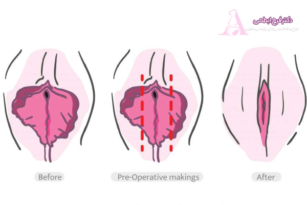 هزینه عمل لابیاپلاستی در ساری چقدر است؟