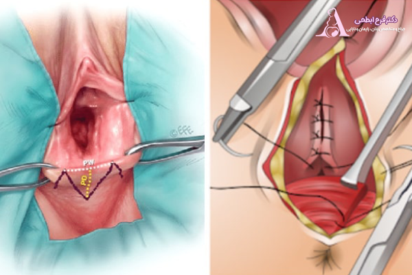 هزینه عمل پرینورافی با لیزر یا جراحی